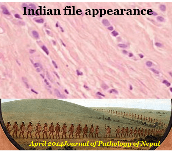 indian file appearance in invasive lobular carcinoma