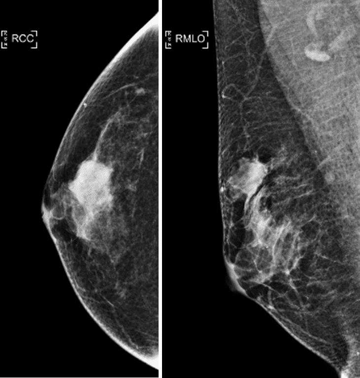 Medullary carcinoma mammography