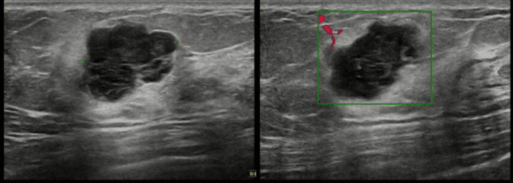 Medullary carcinoma ultrasound
