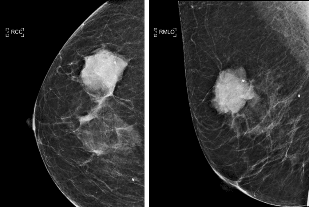 Mucinous carcinoma of the breast mammography