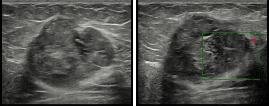 Mucinous carcinoma of the breast ultrasound