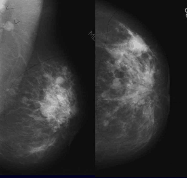 papillary carcinoma of the breast