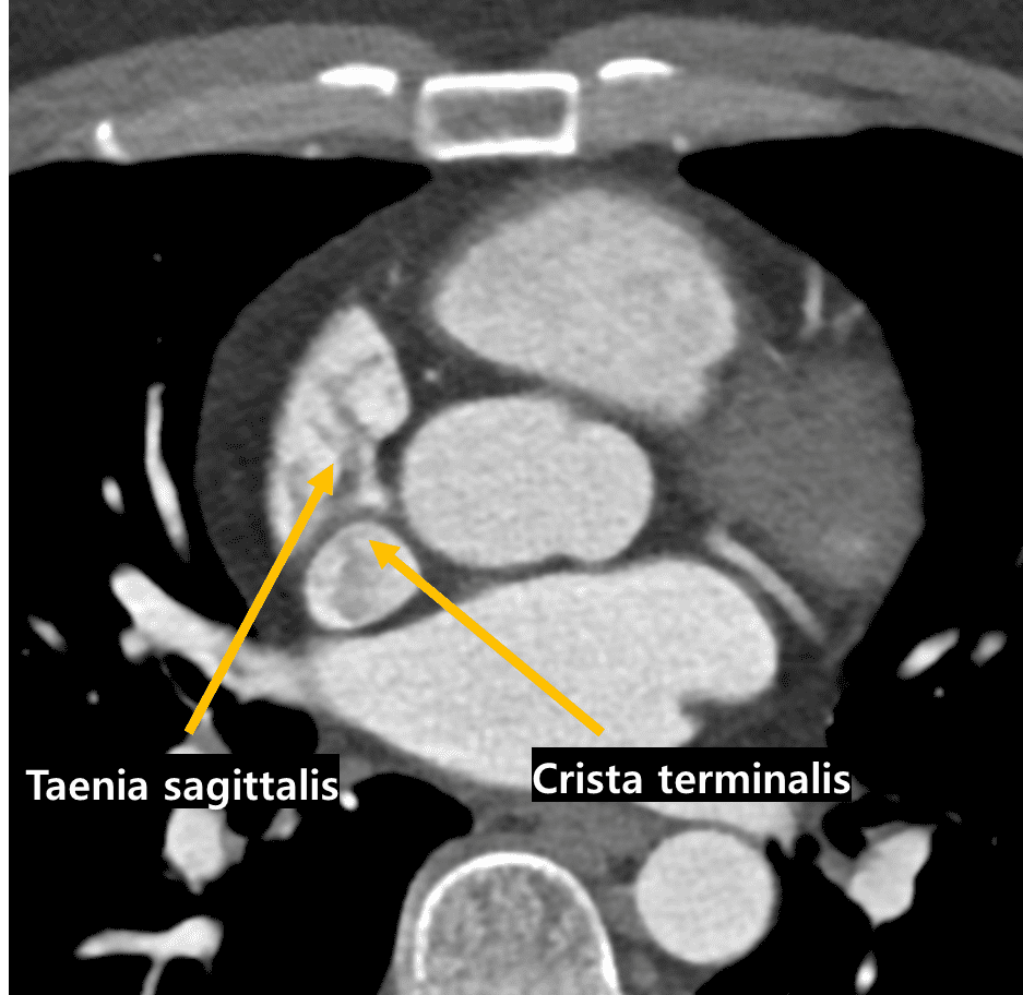 Taenia sagittalis