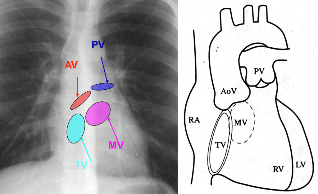 Valve anatomy on chest PA