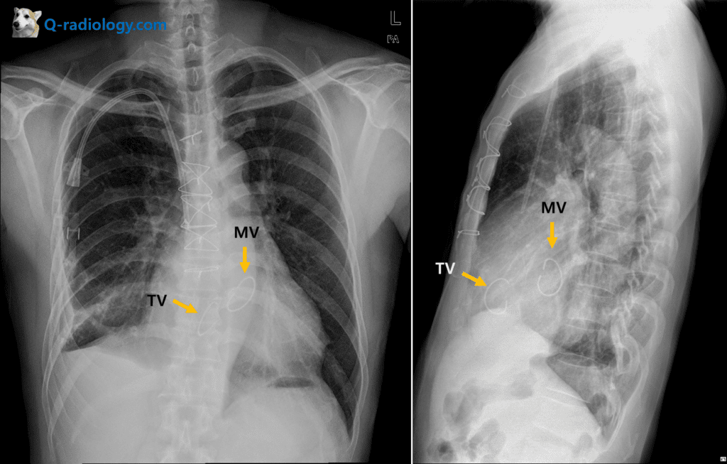 Chest x-ray) mitral and tricuspid valve replacement