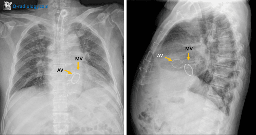 Chest x-ray : mitral and aortic valve replacement
