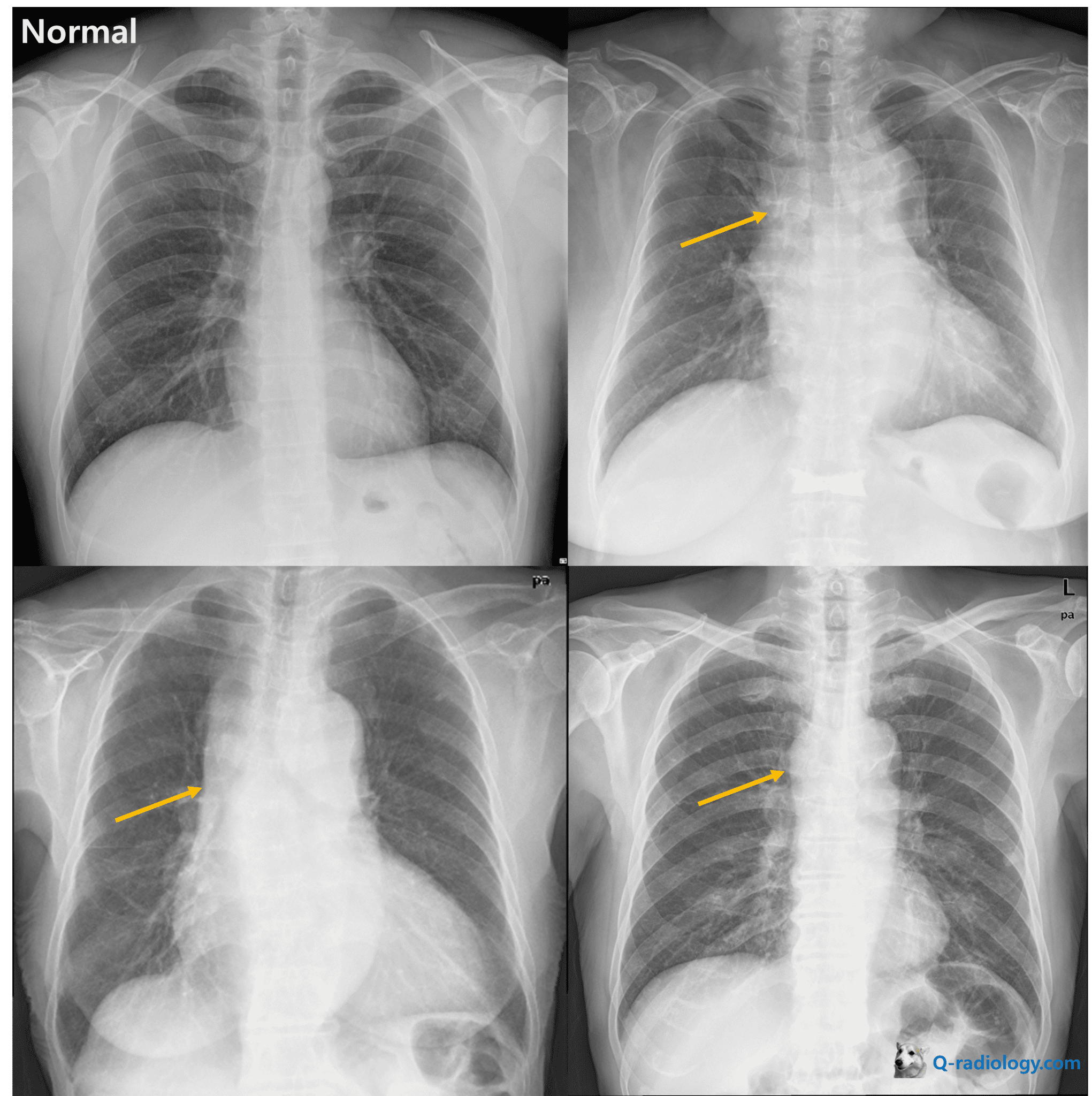 Cardiac Disease Approach On Chest X Rays Q Radiology