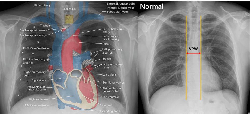 Vascular pedicle width on chest x-ray
