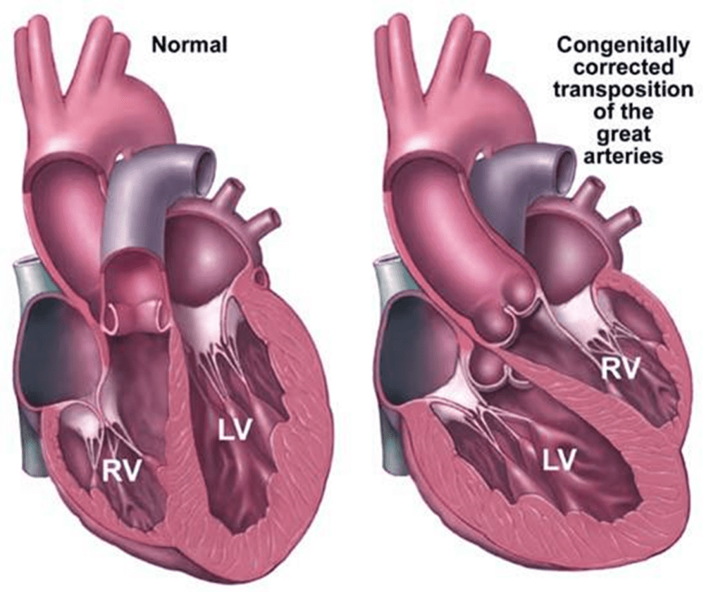 Normal heart versus congenitally corrected TGA