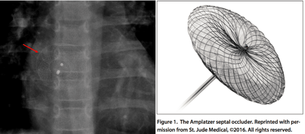 ASD closure device on chest radiograph
