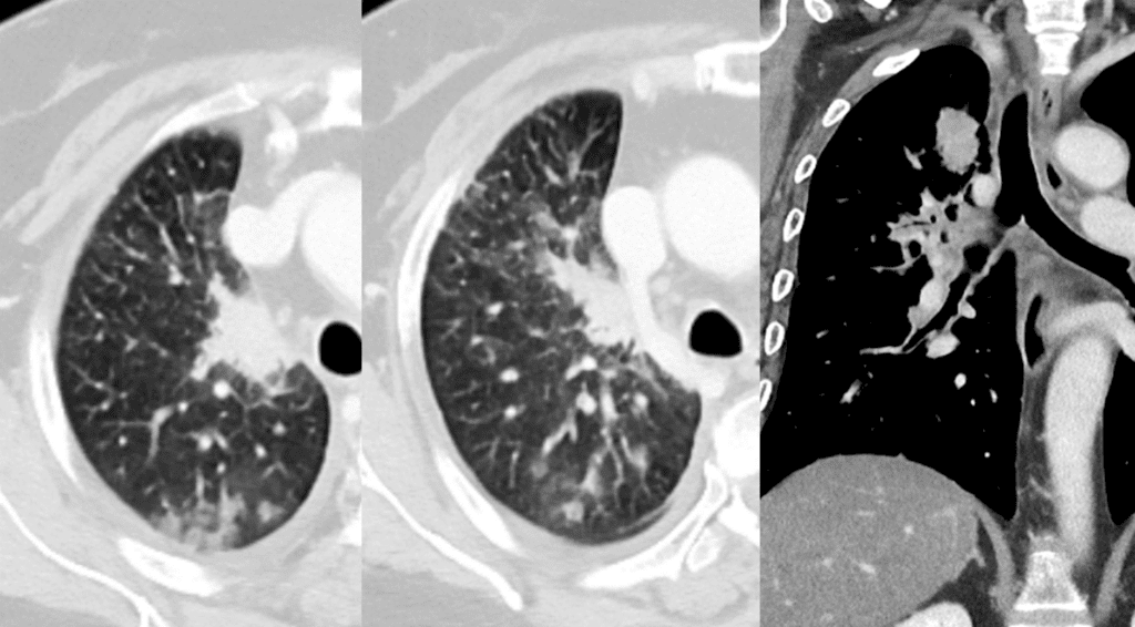 Lung cancer with lymphangitic carcinomatosis