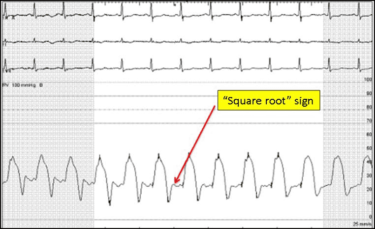 Square root sign in constrictive pericarditis