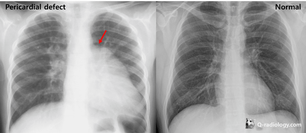Pericardial defect