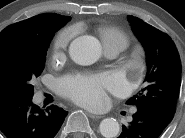 Cardiac thrombus in left atrial appendage
