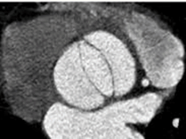 Bicuspid aortic valve