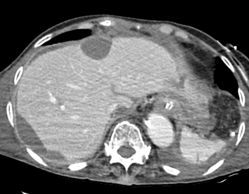 86 year-old female patient who had resection of rectal mucinous adenocarcinoma.
characteristic scalloped appearance of liver is shown.