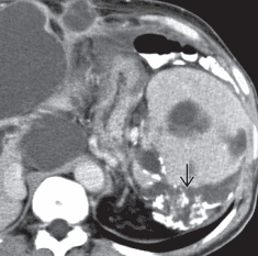 Image from Diagnostic imaging GI 3rd edition
Calcifications, often curvilinear and peripheral, are not uncommonly seen with implants in pseudomyxoma