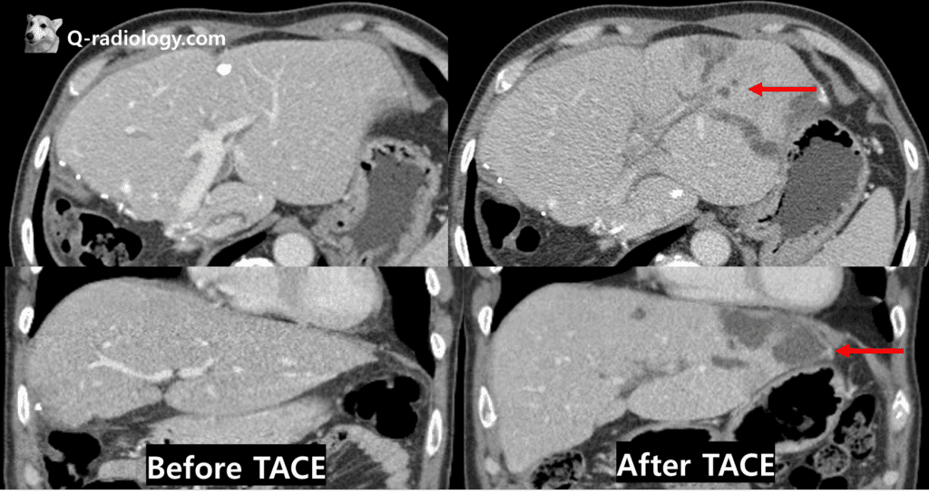 Ischemic bilopathy after TACE #2