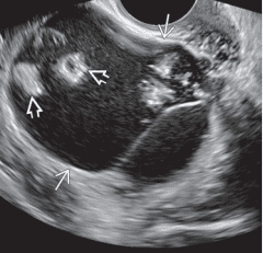 Multilocular cystic ovarian mass with multiple, echogenic, rounded intracystic "struma pearls" a characteristic sonographic feature of struma ovarii. These struma pearls tend to be well vascularized.
Image from Diagnostic imaging, gynecology 