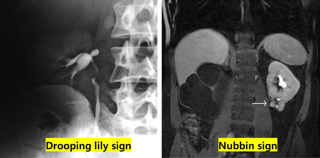 Gaillard F, Duplex collecting system - drooping lily sign. Case study, Radiopaedia.org (Accessed on 12 Dec 2022) https://doi.org/10.53347/rID-12774
Abdominal Radiology volume 41, pages340–341 (2016)