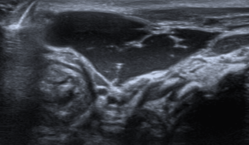Cystic hygroma ultrasound