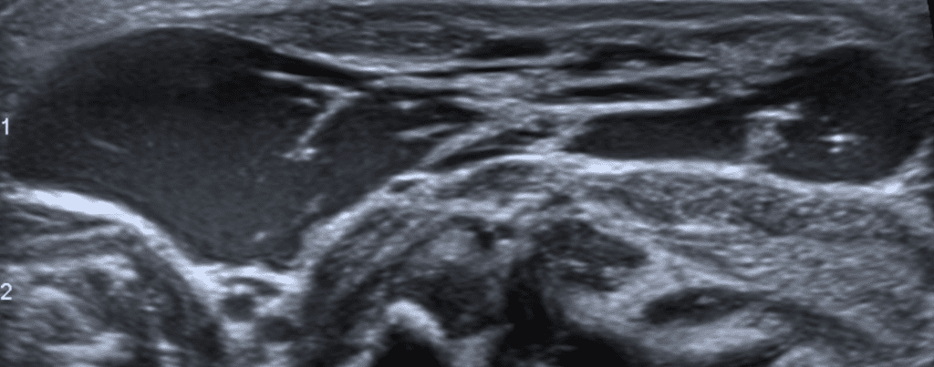 Cystic hygroma ultrasound multilocular transspatial mass