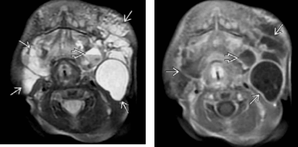 Image from Diagnostic imaging, pediatrics
Multiloculated transspatial macro lymphagitic malformation with mild wall enhancement
