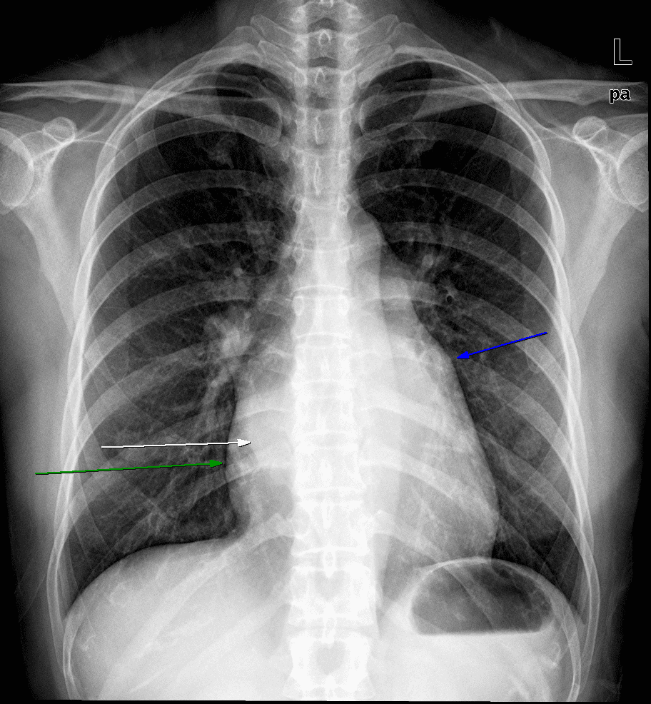 Mitral valvular stenosis on simple radiograph