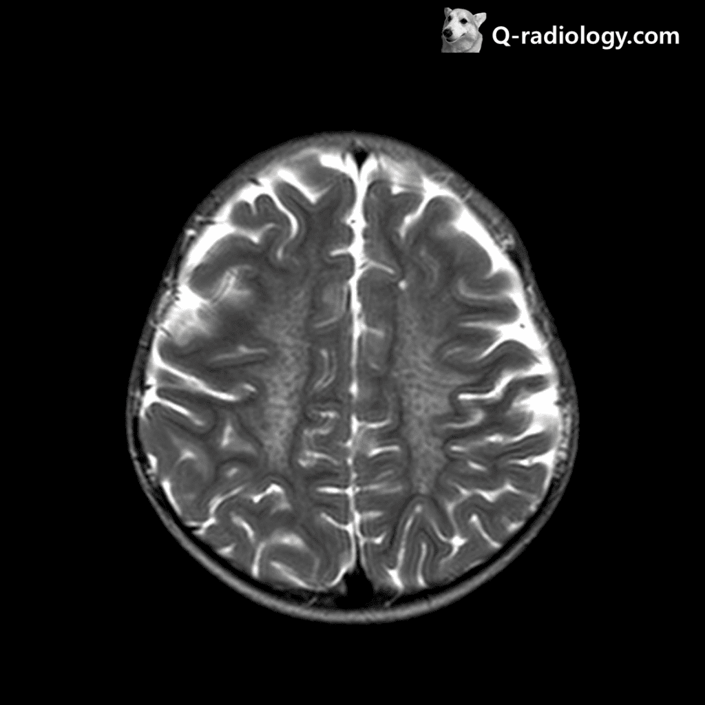 Typical tigroid pattern in bilateral cerebral WMs.