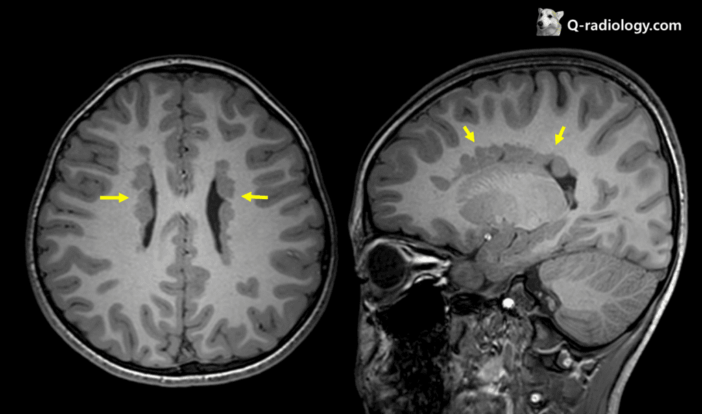Typical subependymal heterotopia, nodular lesions which are iso-signal to grey matter along lateral ventricular wall are seen.
