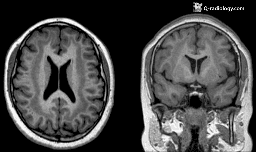 Band heterotopia, ectopic band-like gray matter at both cerebral subcortical white matter such as double cortex