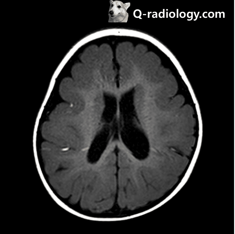 diminished number of cortical sulci and thickening of cerebral cortex involving bilateral frontal and parietal lobes, lissencephaly.