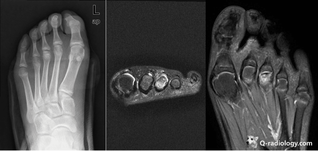 13 year-old girl presented with left foot pain
Simple AP radiograph shows flattening and sclerotic change of 3rd metatarsal head
MRI shows subchondral fracture at 3rd metatarsal head with joint effusion (T2WI)