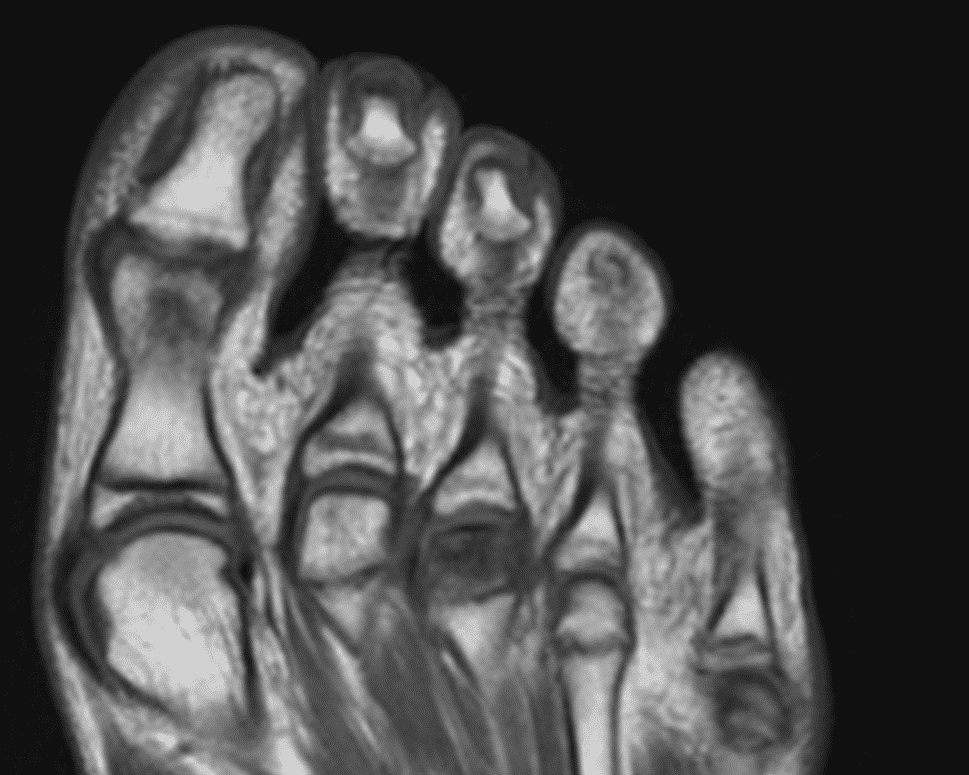 13 year-old girl presented with left foot pain
Simple AP radiograph shows flattening and sclerotic change of 3rd metatarsal head
MRI shows subchondral sclerosis at 3rd metatarsal head (dark signal intensity on T1WI)