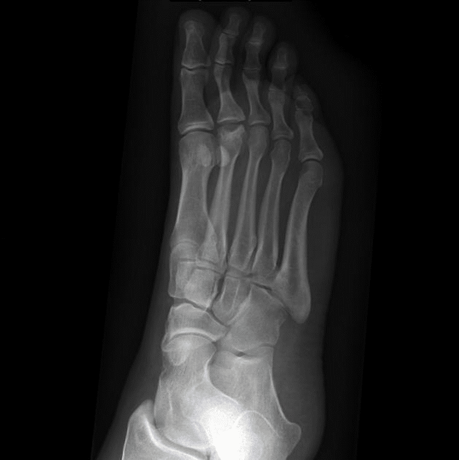 Typical Freiberg's infraction involving 2nd metatarsal head