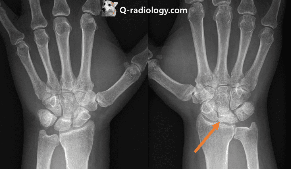 Kienbock's disease : Fragmentation, collapse, sclerosis of right lunate
Note the negative ulnar variance (the ulna is abnormally shortened, by more than 2.5 mm, compared to the radius)