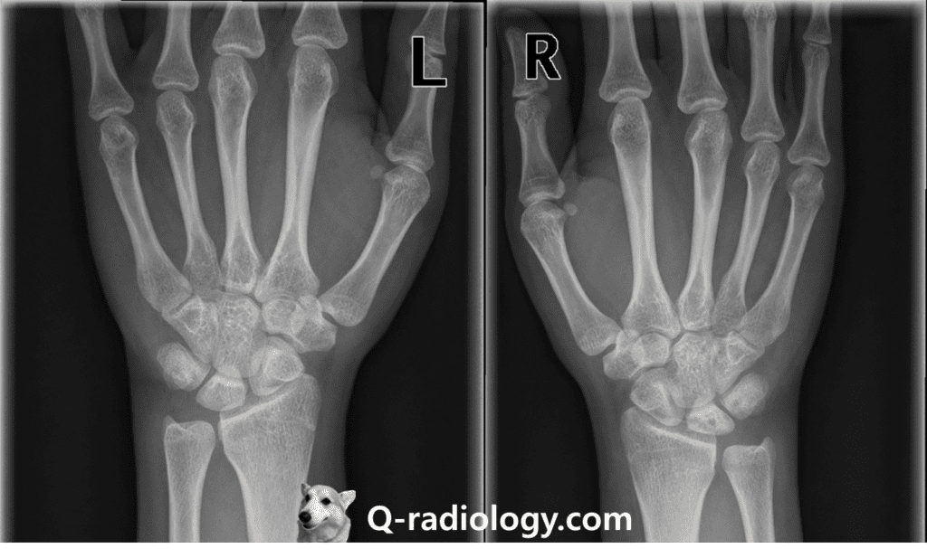 Wrist AP view of 20 year-old woman
Radiolucency and sclerosis are shown in right lunate with negative ulnar variance, suggestive Kienbock's disease.