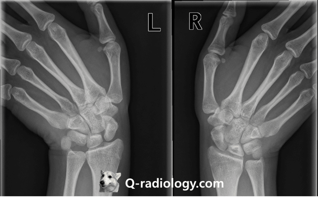 Ulnar deviation view of 20 year-old woman
Radiolucency and sclerosis are shown in right lunate (compare with left side lunate) with negative ulnar variance, suggestive Kienbock's disease.
the purpose of this kind of additional view is to free the scaphoid from bony superimposition. 