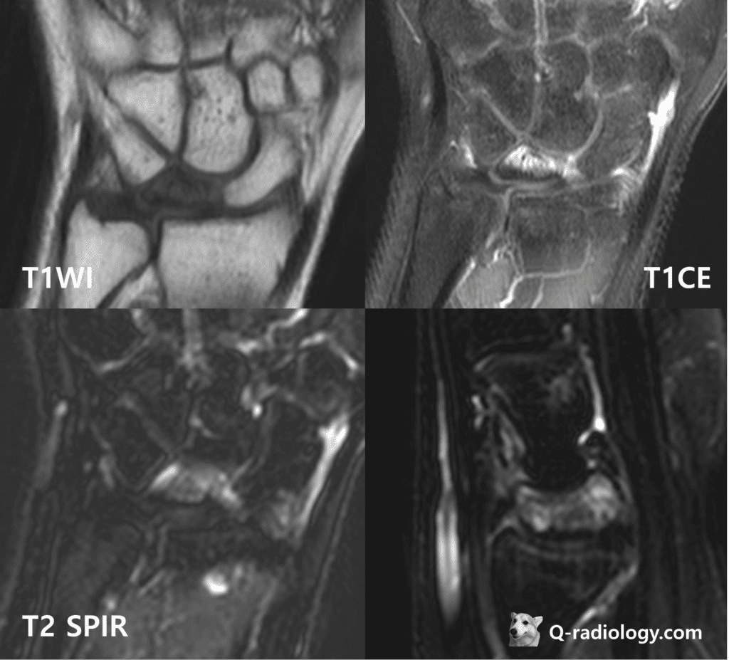 MRI of right wrist of the same patient (20 year-old woman)
the images reveal edematous change of lunate (low SI on T1WI with enhancement, high signal intensity on T2WI) and sclerosis of lunate (peripheral low signal on T1 and T2WI, but the finding is better visualized on simple radiograph than MRI)