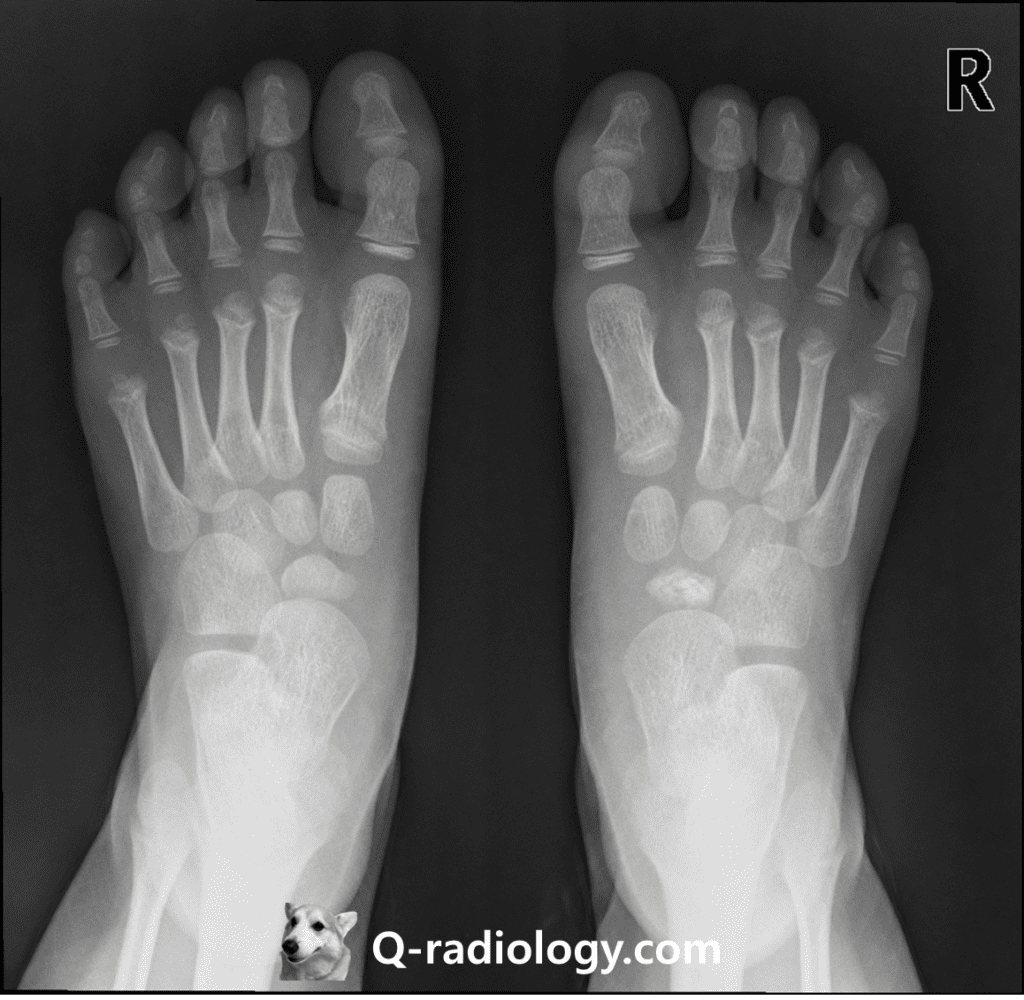 4 year-old boy presented with right foot pain
flattening and sclerotic change of right navicular bone suggesting Kohler's disease