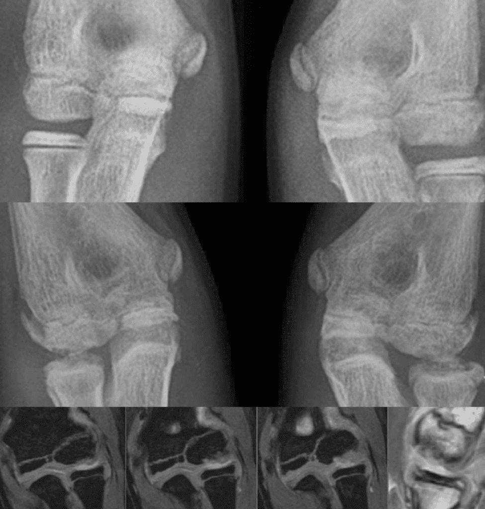 Panner disease (10 y/o girl)
sclerosis and bony fragmentation of left capitellum 
also seen in MRI 