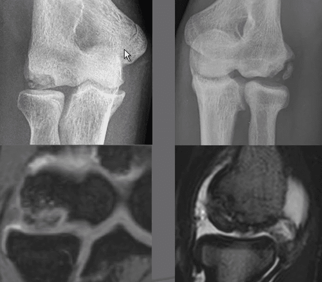 Differential diagnosis : osteochondritis dissecans in elbow