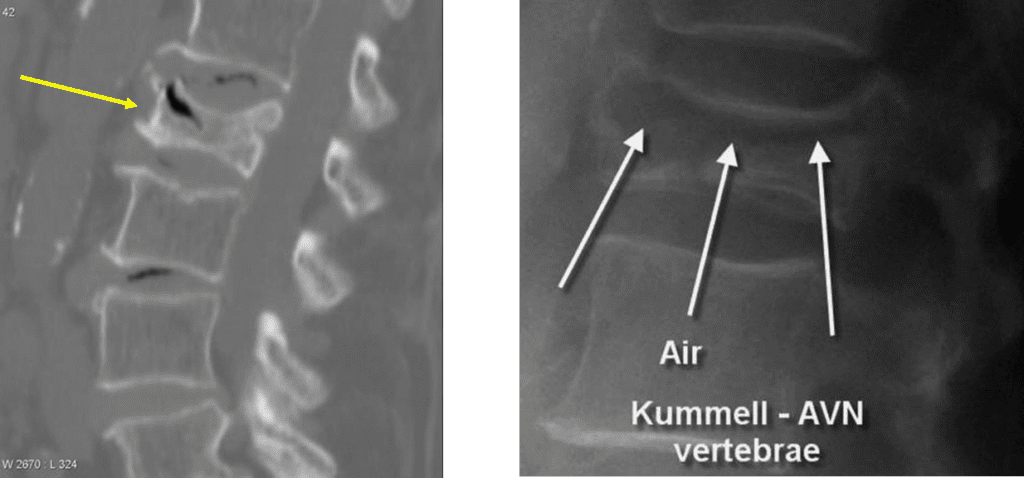 Kummel disease radiology