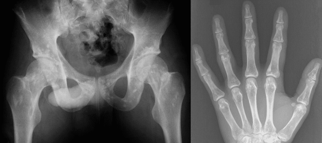 Osteopoikilosis, multiple high density lesions suggesing enostosis