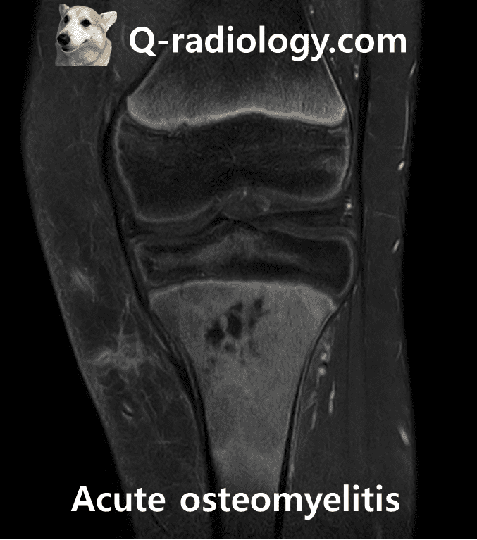 Acute osteomyelitis