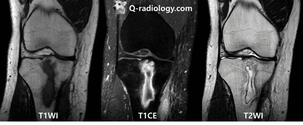 R/O Brodie's abscess.
Well-defined layered rim enhancing lesion with fluid collection in central cavity in medullary cavity of proximal epi- and metaphysis of tibia 

