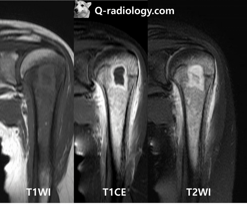 Well-defined layered rim enhancing lesion with fluid collection in central cavity in medullary cavity of proximal epi- and metaphysis of proximal humerus: R/O brodie's abscess.