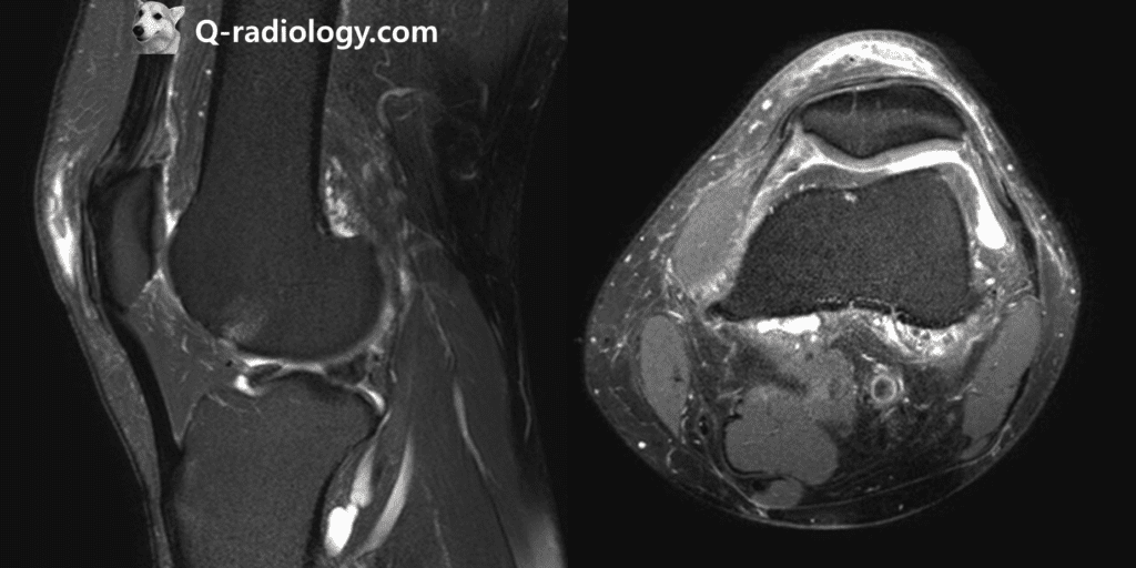 MRI finding of Prepatellar bursitis