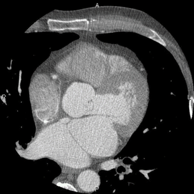 CT finding of Cor triatriatum sinister : Left atrium is divided by a thin membrane 