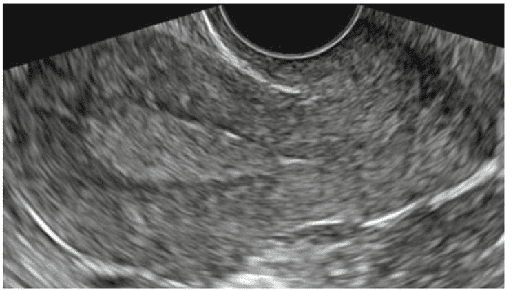 Luteal phase (Secretary phase) endometrium showing a homogenously thickened hyperechoic stripe